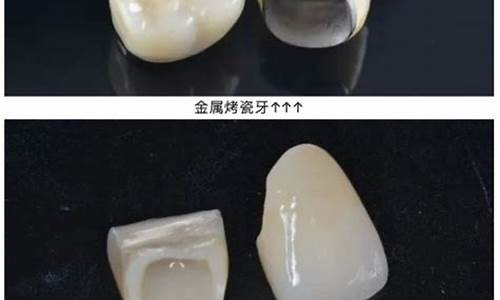 高考金属牙套怎么办_高考牙有金属